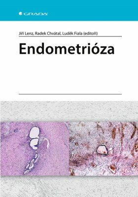Endometrióza - e-kniha