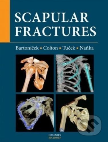 Scapular fractures - Jan Bartoníček, Michal Tuček, Ondřej Naňka