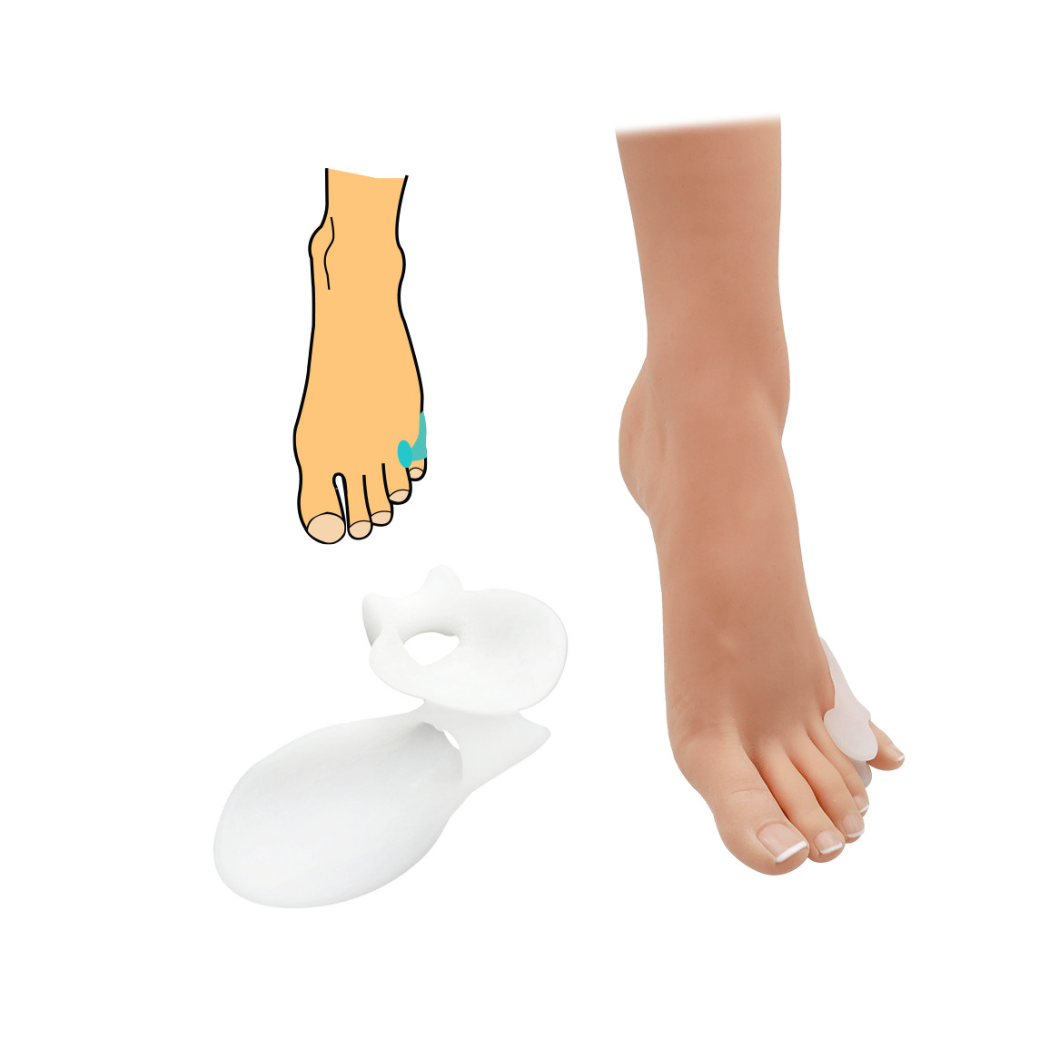 Korektor na malíček s chráničem HealMed 1 pár - bílý