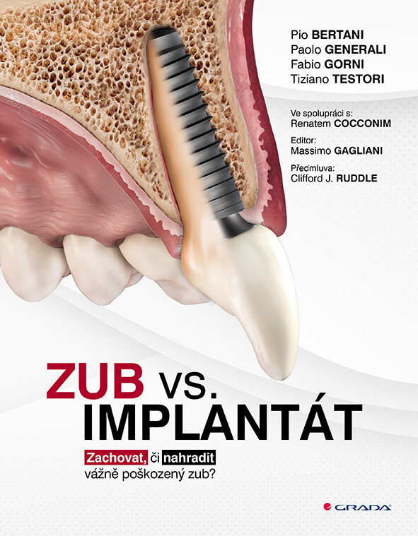 E-kniha: Zub vs. implantát od Bertani Pio