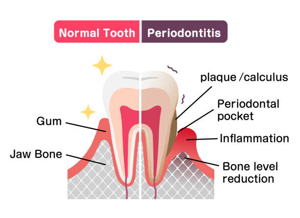 Barks_japan Plakát, Obraz - Comparison of normal teeth and periodontal, Barks_japan, 40 × 30 cm