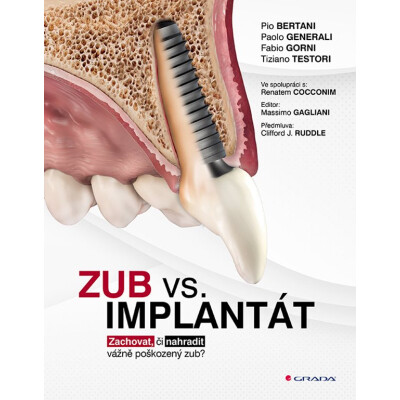 Zub vs. implantát