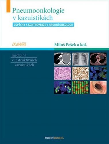 Pešek Miloš A Kolektiv: Pneumoonkologie V Kazuistikách