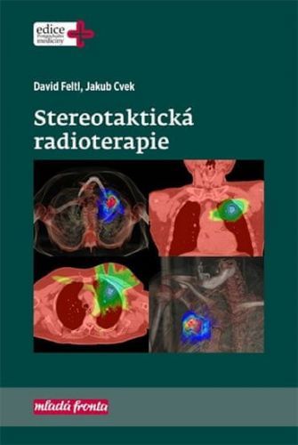 Feltl David, Cvek Jakub,: Stereotaktická Radioterapie
